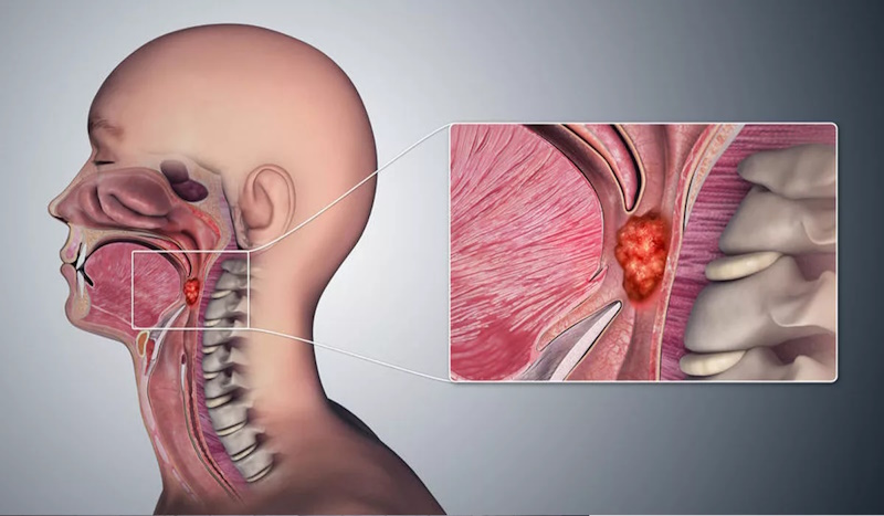 IMG_01 рак носоглотки у Києві